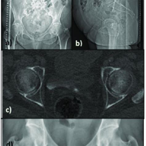 Pelvimetry performed using conventional radiography included with... | Download Scientific Diagram