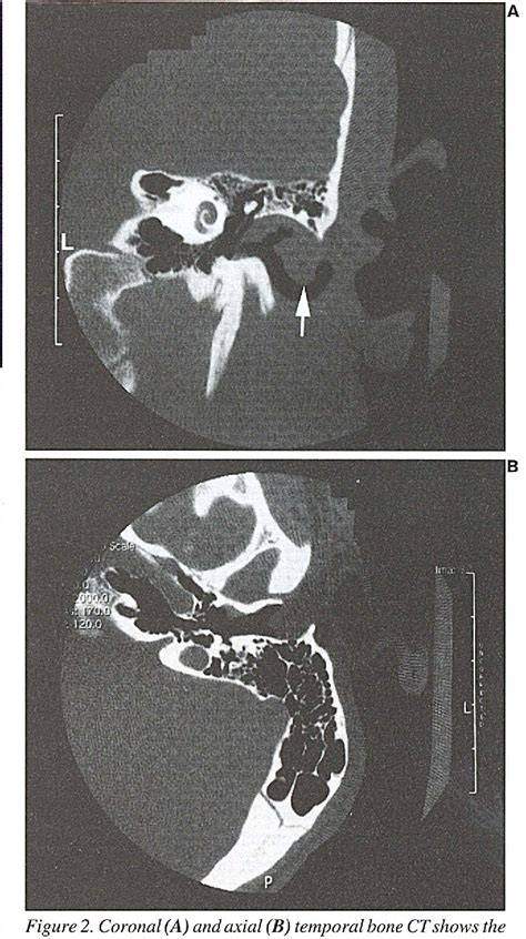 Figure From A Rare Case Of A Sebaceous Nevus In The External Auditory