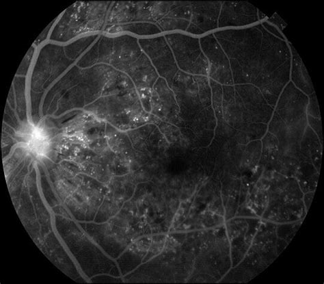 Fluorescein and Indocyanine green (ICG) Angiography Chicago | University Retina