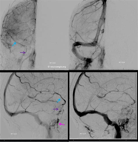 Pulsatile Tinnitus Venous Sinus Stenosis And Stenting