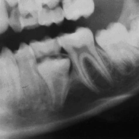 Detail Of Same Orthopantomograph Showing Lower Left Quadrant Observe