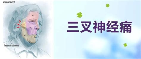 【在线答疑】70岁三叉神经痛患者如何选择治疗方法？能否彻底治痛？ 知乎