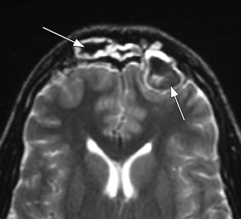 Imaging Features Of Invasive And Noninvasive Fungal Sinusitis A Review