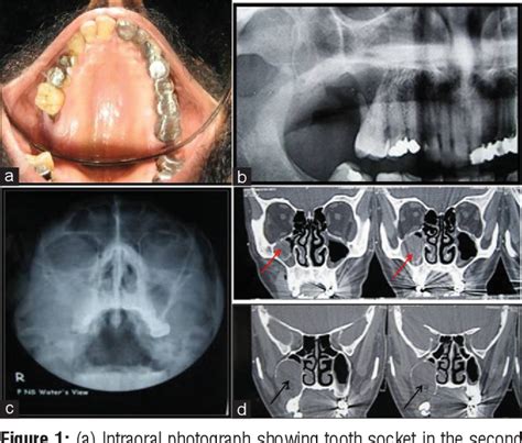 Figure 1 From Plexiform Unicystic Ameloblastoma With Adenoid