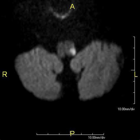 Wallenberg Syndrome - Physiopedia