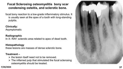 Chap 4b Osteomyelitis And Osteoradionecrosis Of Jaws Jawppt