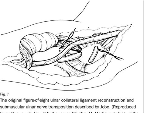 Figure 7 From Ulnar Collateral Ligament Reconstruction In Throwing Athletes A Review Of Current