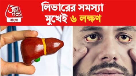 Fatty Liver Symptoms লিভার খারাপের এই ৬ লক্ষণ দেখা দেয় মুখেই সতর্ক