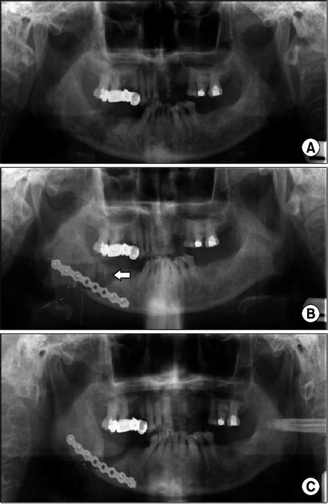 Mandible Fracture Resulting From Osteomyelitis A Panoramic View Download Scientific Diagram