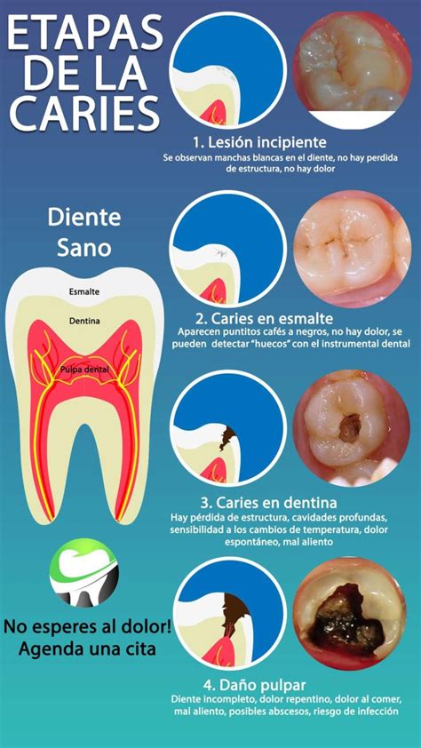 Caries C Mo Se Desarrollan Y Prevenir Blog Dental Irriak