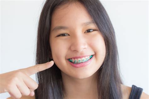 Alternatives To Straightening Teeth With Traditional Braces Visalia