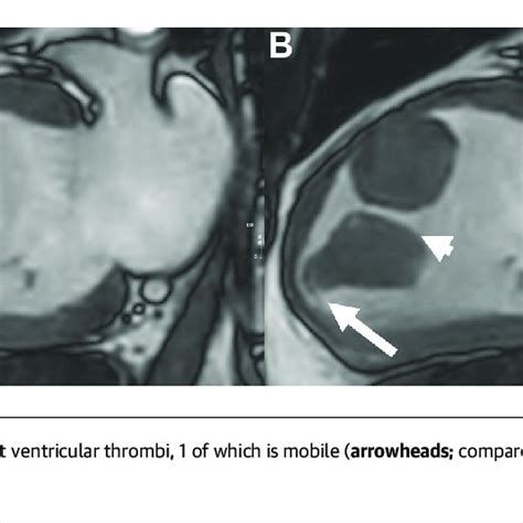 Chamber Steady State Free Precession Cardiac Magnetic Resonance