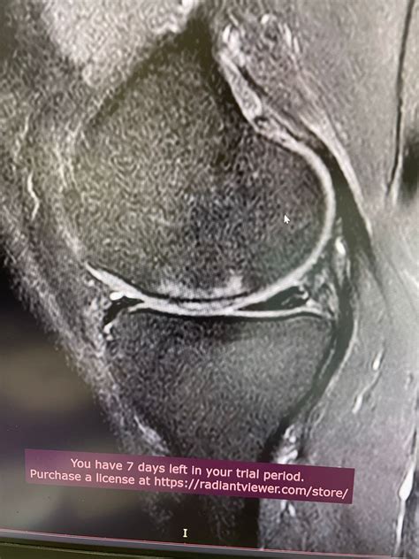 Explore the Success Stories of Knee Cartilage Transplants | Gallery