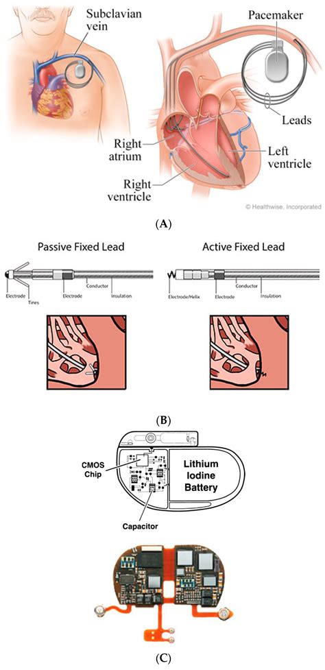 Implantable Cardioverter Defibrillator Vs Pacemaker