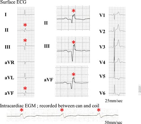 Twelve‐lead Electrocardiography Shows An Rsr Pattern In Inferior Download Scientific Diagram