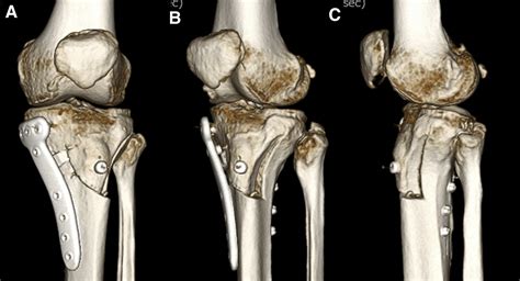 Distal Tibial Tuberosity Arc Osteotomy In Open Wedge Proximal Tibial