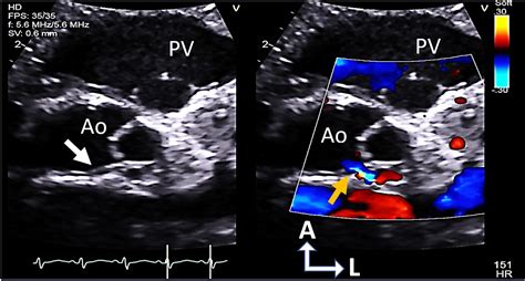 Quadricuspid Aortic Valve With Guarded Left Coronary Artery Ostium In