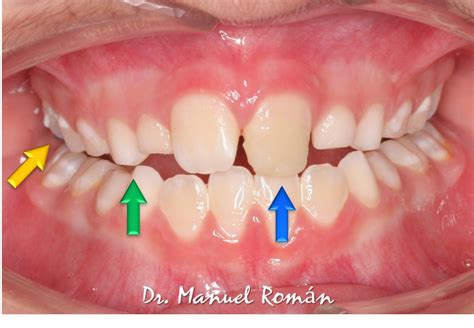 Caso clínico mordida cruzada anterior Pistas Composite manuelroman