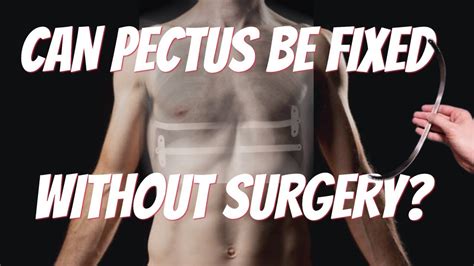 Can Pectus Excavatum Be Fixed Without Surgery Youtube