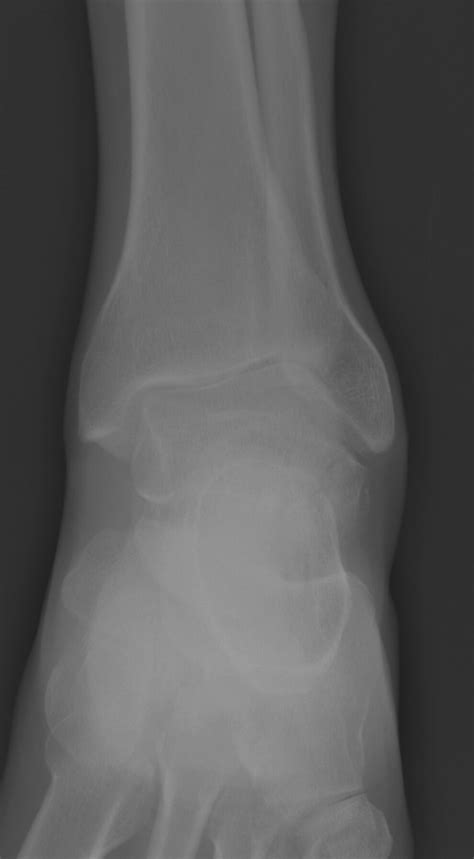 Snowboarder Fracture — Ortho Teaching Files — Nuem Blog