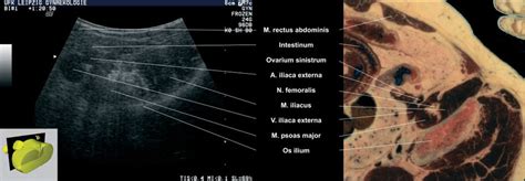 Sectional Plane 5 Abdominal Sonography Lateral Transverse Section For