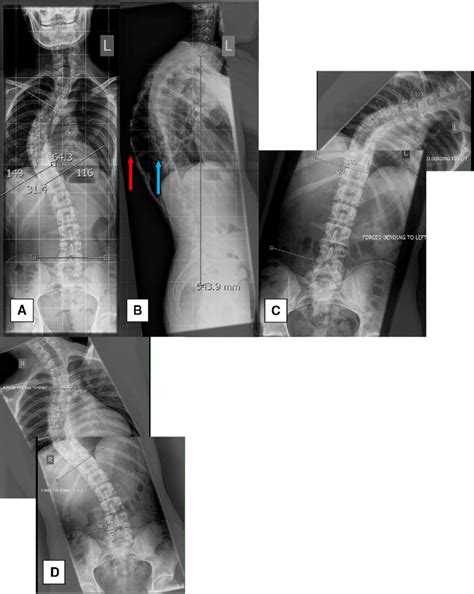 Pre Operative X Rays A Anterior Posterior Image 64° Right Thoracic Download Scientific