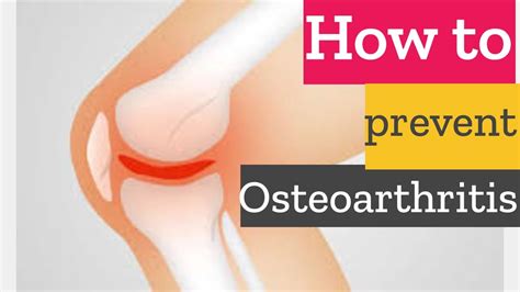 How To Lose Weight And Prevent Osteoarthritis Youtube