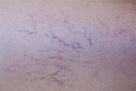 Skin Concerns Veins D Thomas Clinic