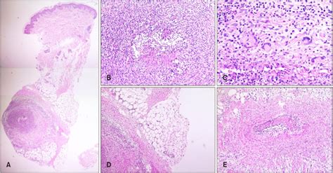 A Low Magnification Of Histologic Findings Of The Lesions On The