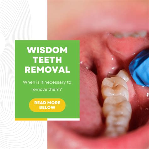 Wisdom Teeth Removal Clinic - Affordable Tooth Extraction