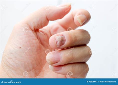 Fungus Infection On Nails Hand Finger With Onychomycosis Soft Focus