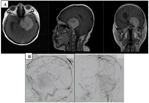 The illustrative case from type of cortical | Download Scientific Diagram