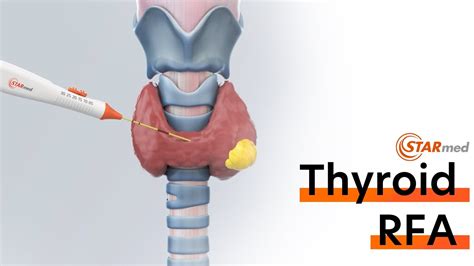 Thyroid Radiofrequency Ablation Rfa Procedure Youtube