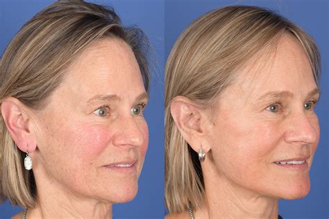 Facelift Before And After 30 Weber Facial Plastic Surgery