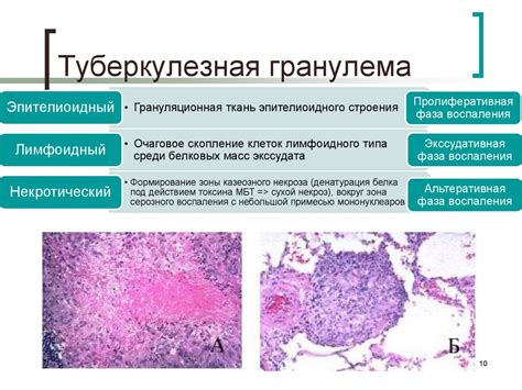 Хронические специфические инфекции - презентация онлайн