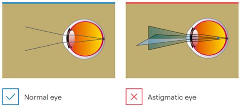 Astigmatism Operation How Is Surgery Imo