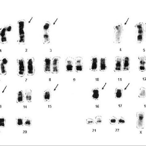 G Banded Male Karyotype In All Patient Showing Multiple Whole Download Scientific Diagram