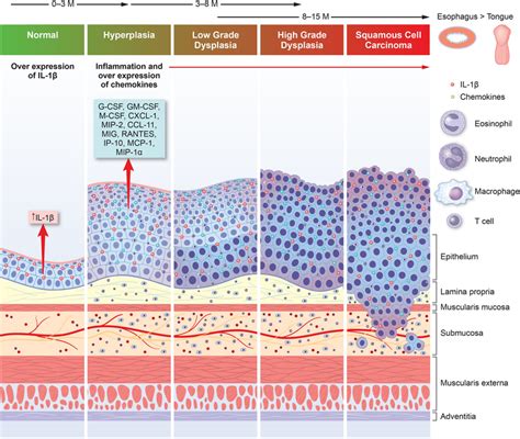 Il 1β Mice As A Model For Esophageal And Oral Scc Progression The Download Scientific Diagram