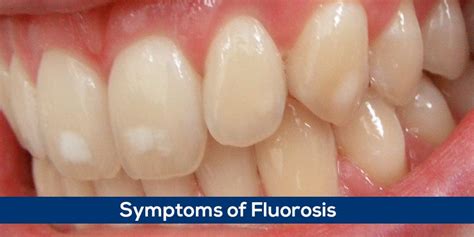 Fluorosis – Symptoms of Fluorosis - SGT University