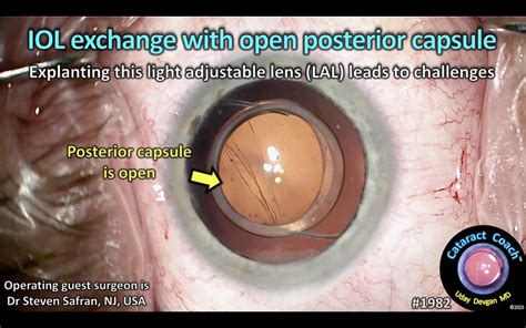 1982 Iol Exchange Open Posterior Capsule Cataract Coach