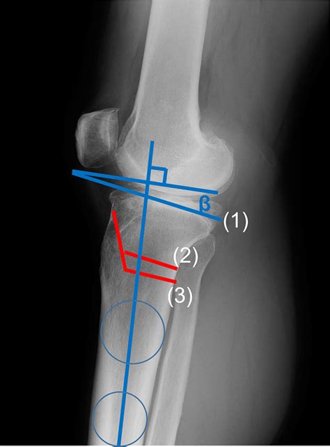 Simultaneous Correction Of Varus Deformity And Posterior Tibial Slope