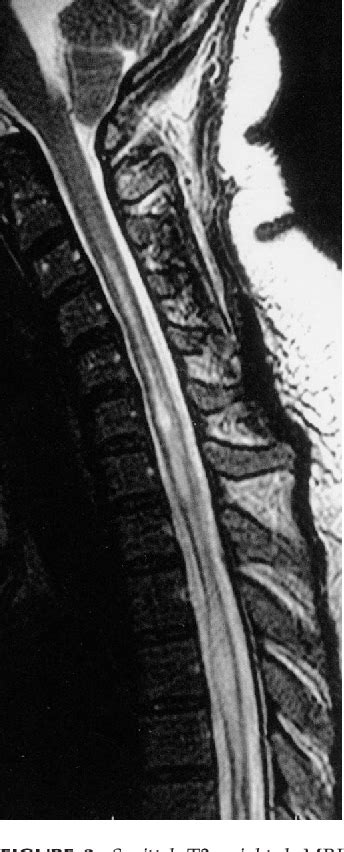 Figure 1 From Endoscopic Third Ventriculostomy Semantic Scholar