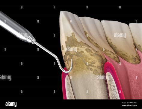 Oral Hygiene Scaling And Root Planing Conventional Periodontal Therapy Medically Accurate 3d