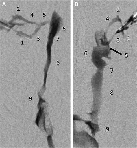 Nasolacrimal Duct Obstruction Advances In Ophthalmology And Optometry