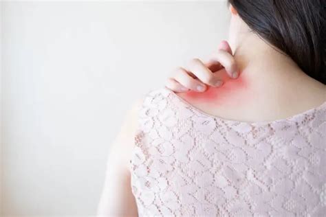 Hives – Symptoms, Causes and Treatment