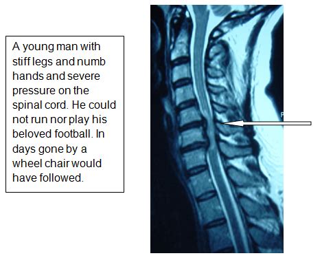 Cervical vertebrectomy