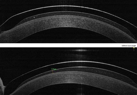 A Coherent Strategy For Fitting Scleral Lenses