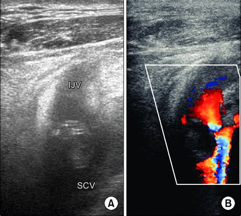 Ultrasonographic Images A Echogenic Mass On The Junction Of Internal Download Scientific