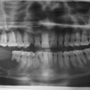 Orthopantamograph Showing A Well Defined Multilocular Lesion On Right