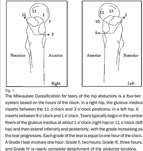 Figure 1 From Surgical Treatment Of Hip Abductor Tendon Tears Semantic Scholar